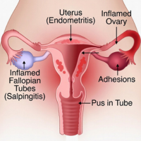 An anatomical diagram of the female reproductive system showing uterus, fallopian tubes, and ovaries with labels for endometriosis, salpingitis (inflamed tubes), and adhesions.