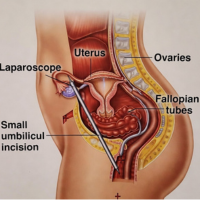 Diagram of female pelvic organs showing the uterus, fallopian tubes, ovaries, and a laparoscope entering through a small umbilical incision.