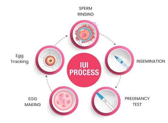 IUI Process
